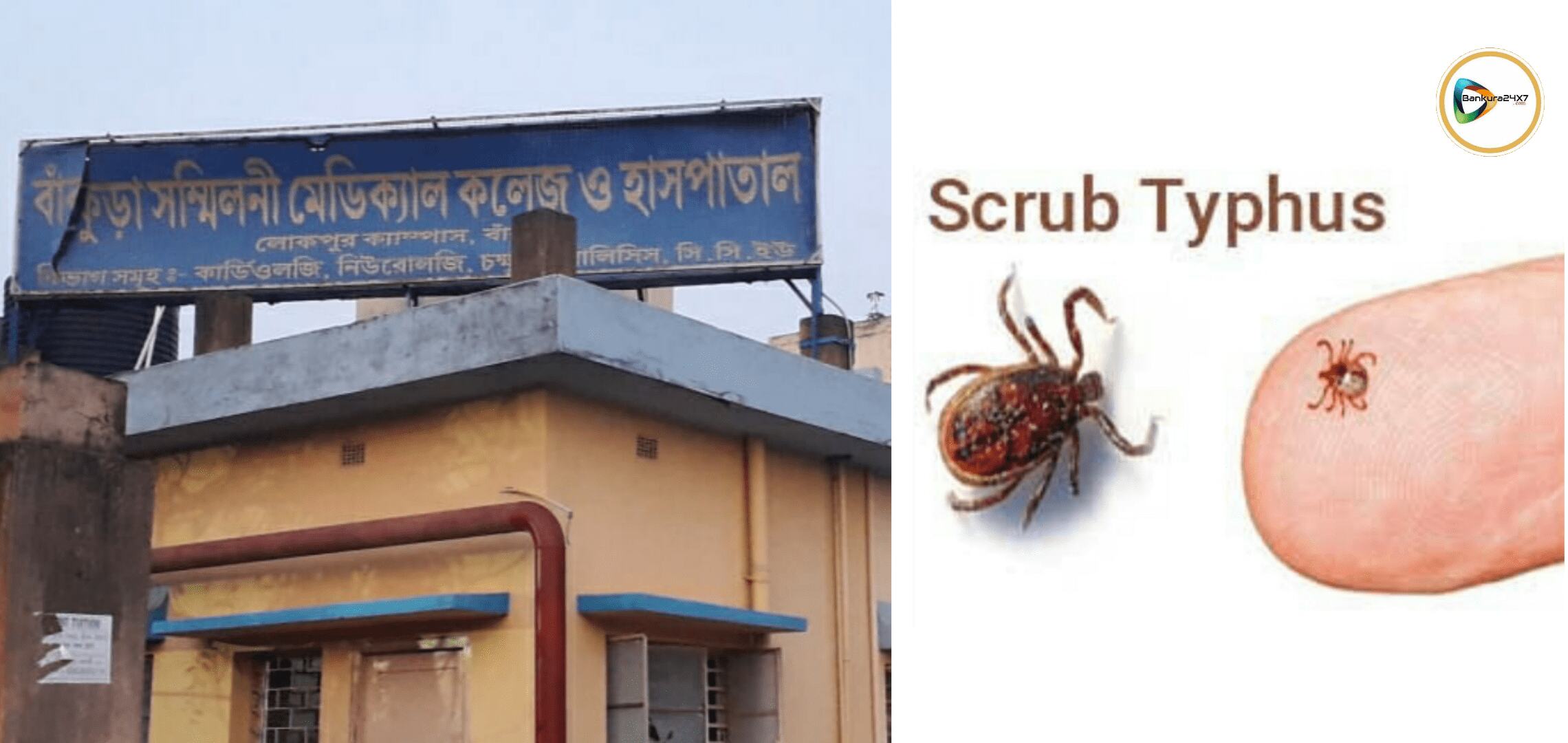 করোনা নয়,বাঁকুড়া মেডিকেলের আইসোলেশন ভর্তি তালডাংরার মহিলা আক্রান্ত স্ক্রাব টাইফাসে। করোনা নয়,বাঁকুড়া মেডিকেলের আইসোলেশন ভর্তি তালডাংরার মহিলা আক্রান্ত স্ক্রাব টাইফাসে।