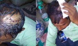 সিমলাপালে ঘুমন্ত অবস্থায় তৃণমূল কর্মীর মাথায় অস্ত্রের কোপ, অভিযোগের আঙ্গুল বিজেপির দিকে, অভিযোগ অস্বীকার বিজেপির